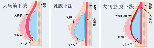 豊胸図