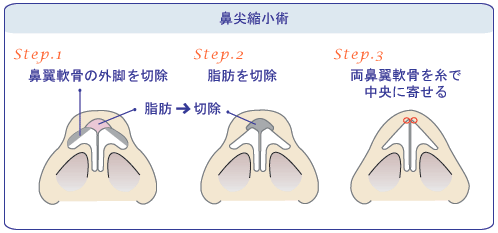 鼻突縮小術