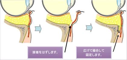 経結膜的眼窩脂肪移動術（トラコンハムラ）