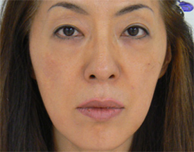 目のくま-経結膜的眼窩脂肪移動術（トラコンハムラ）の症例写真（治療後）