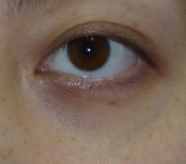 目のくま-トレチノイン治療とQスイッチレーザーの症例写真（治療前）