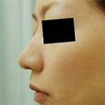 鼻先縮小の症例写真（手術後）