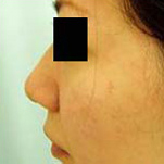 鼻先縮小の症例写真（手術前）