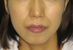 鼻唇溝のプチ整形－ヒアルロン酸注射の症例写真（注入前）