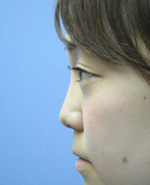 鼻のプチ整形－ヒアルロン酸注射の症例写真（注入直後）