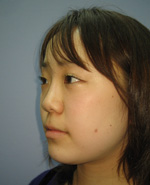 鼻のプチ整形－ヒアルロン酸注射の症例写真（注入直後）