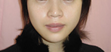 エラ（噛筋）のプチ整形－ボトックス注射の症例写真（注入後6ヶ月）