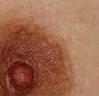 症例写真：トレチノインによる乳頭・乳輪の漂白（治療開始後3ヶ月）