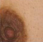 症例写真：トレチノインによる乳頭・乳輪の漂白（治療前）